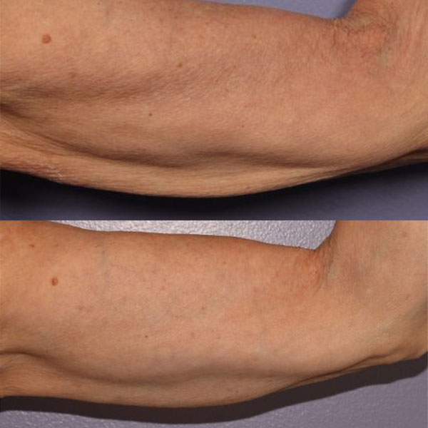 Side-by-side comparison of an arm before and after skin tightening or cosmetic treatment, showing reduced sagging and smoother skin in the after image.