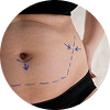 Lipoma Removal