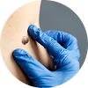 Seborrheic Keratosis Removal