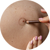 Mole Removal