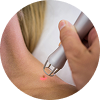 Skin Tag Removal