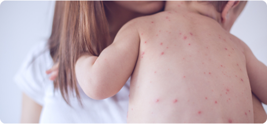 Baby measles