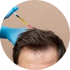 PRP – Hair Loss