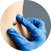 Seborrheic Keratosis Removal