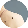 Epidermoid Cyst Removal