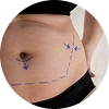 Lipoma Removal