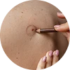 Mole Removal