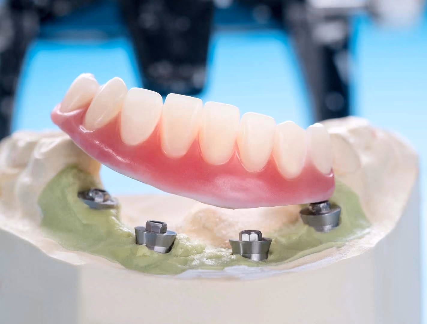 Implant-Retained Dentures