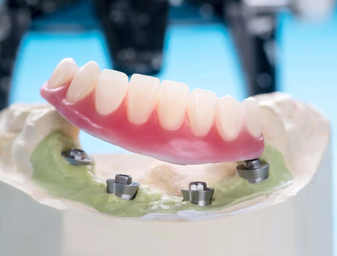 Implant-Retained Dentures