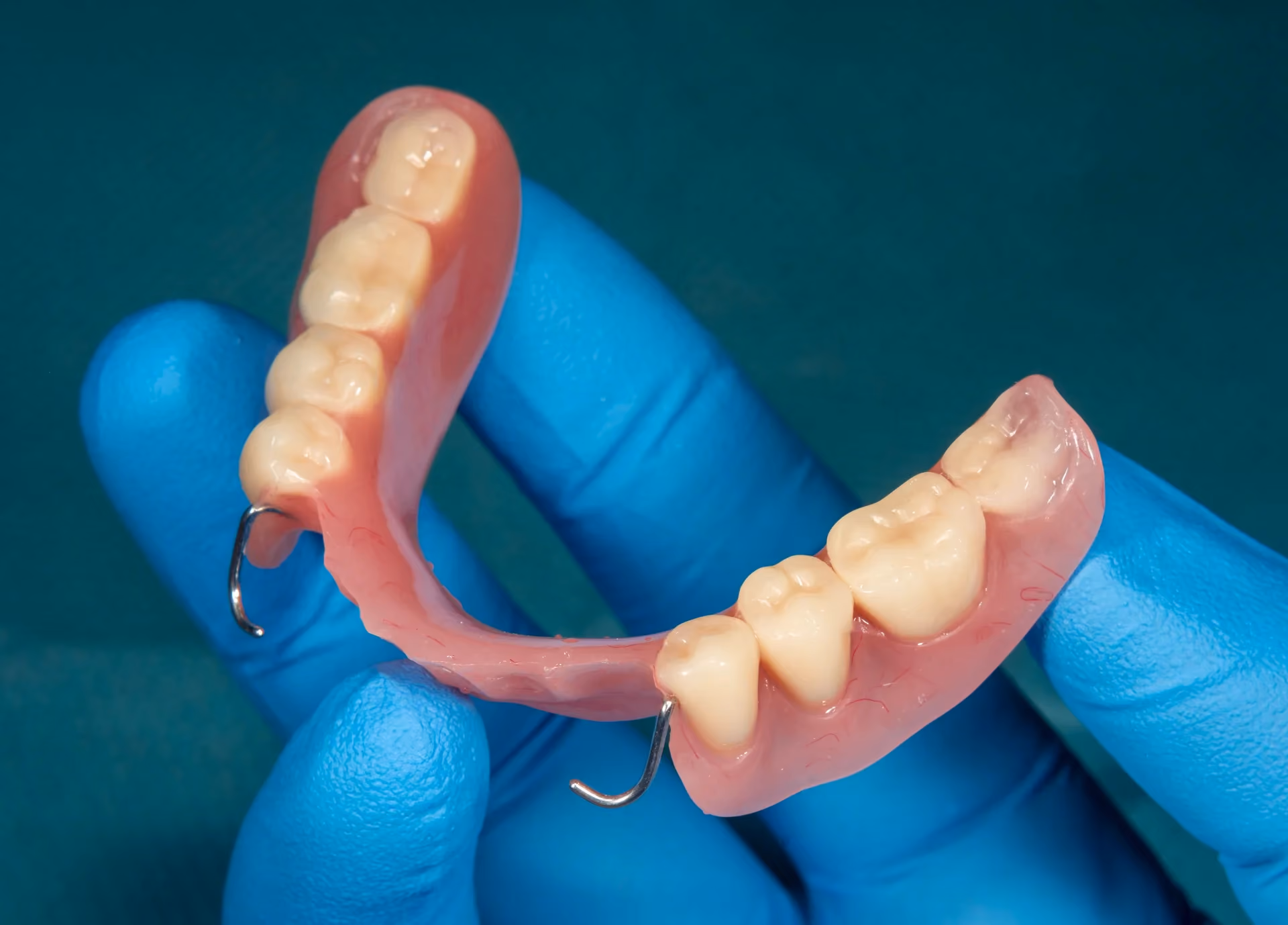 Implant-Retained Partials