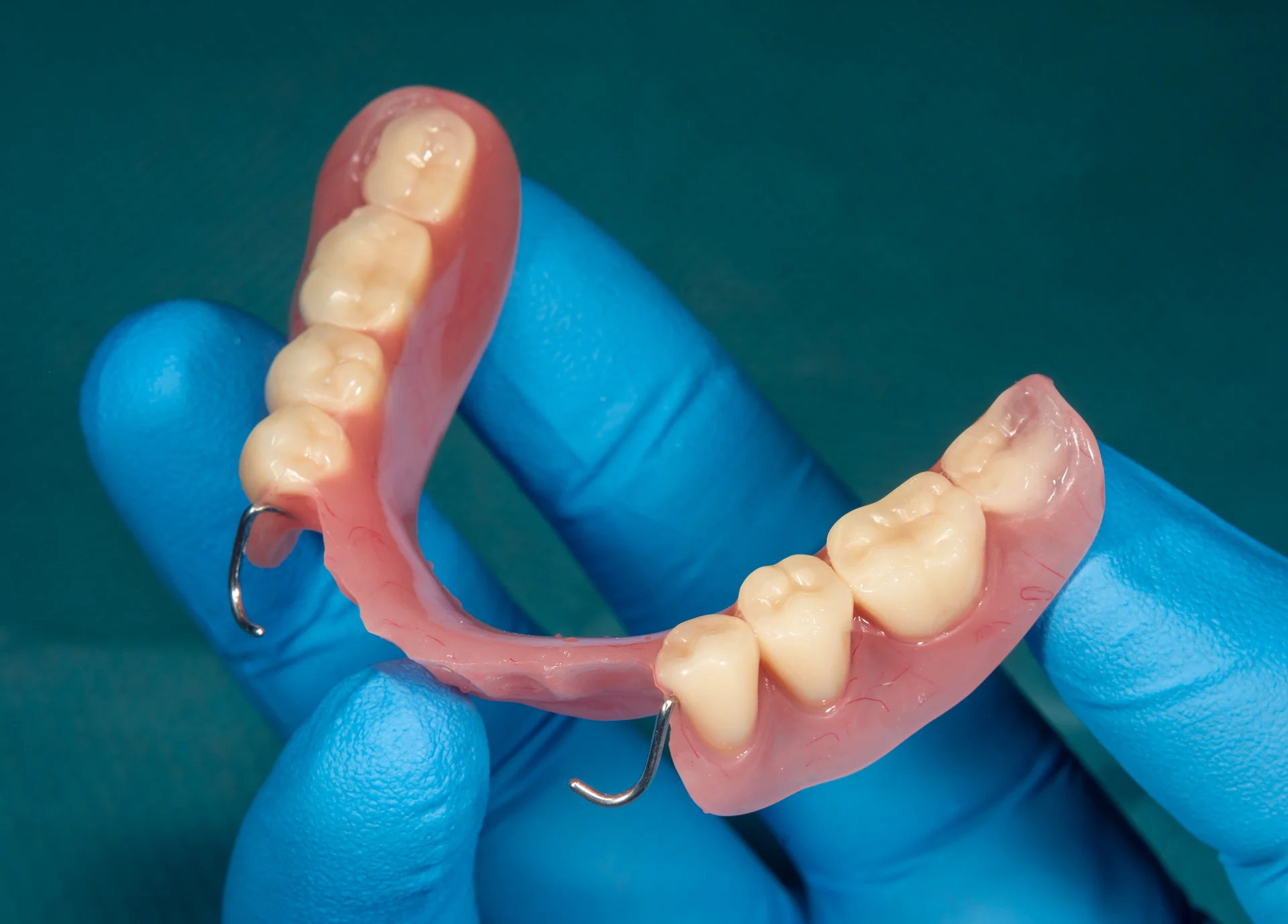 Implant-Retained Partials