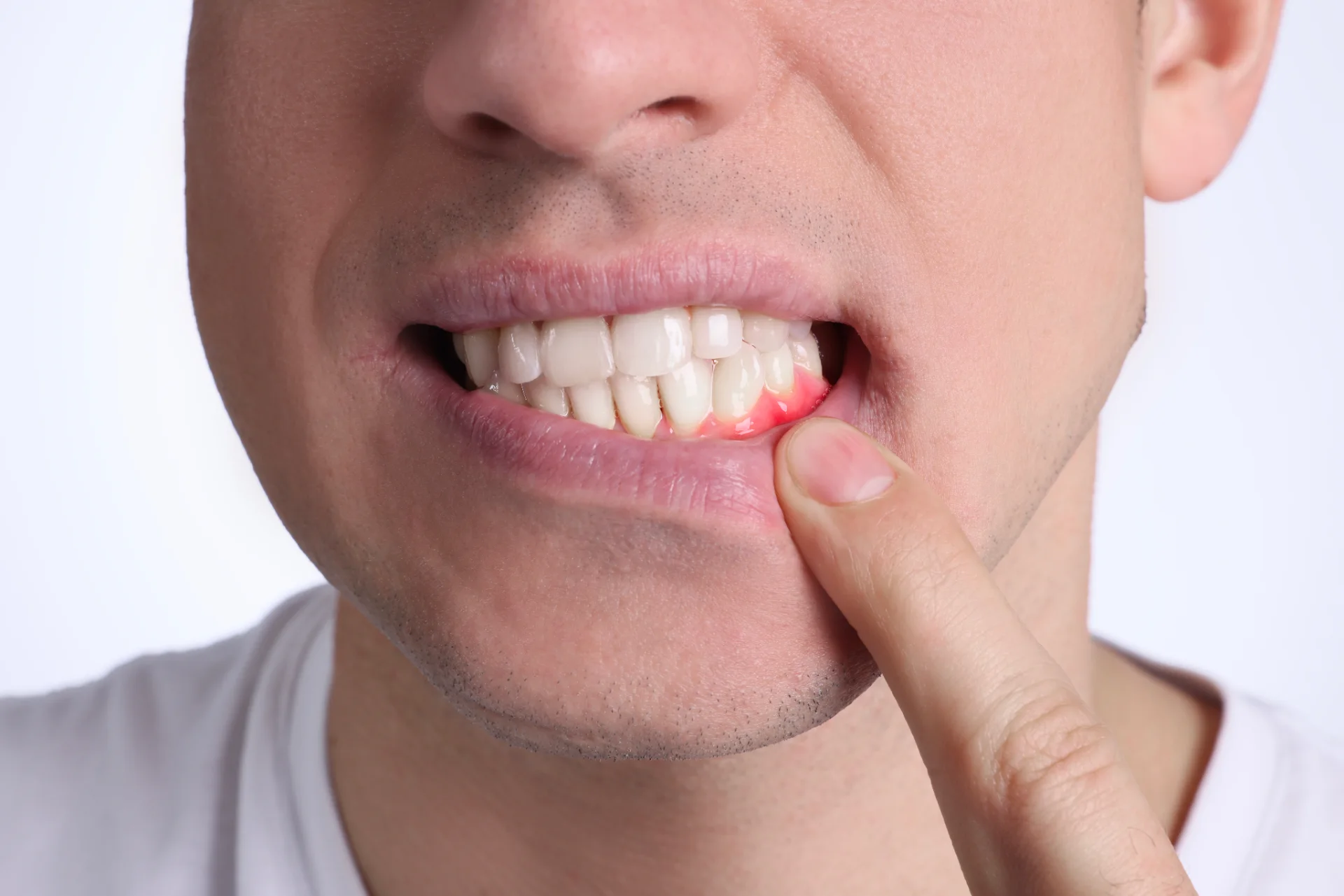 How Can I Defend Against Gum Recession?