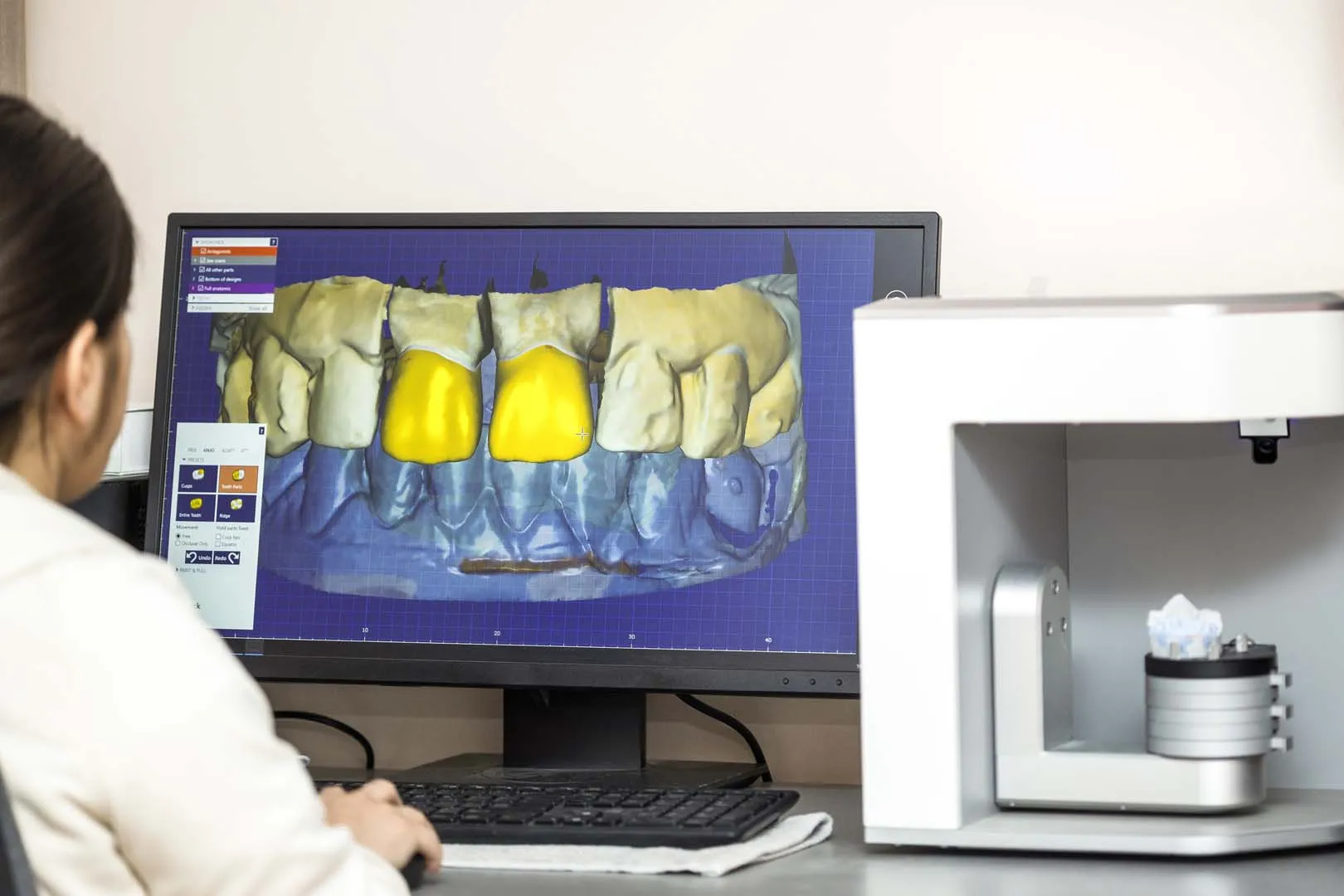 No More Putty: How iTero Digital Impressions Perfect Your Restorative Fit