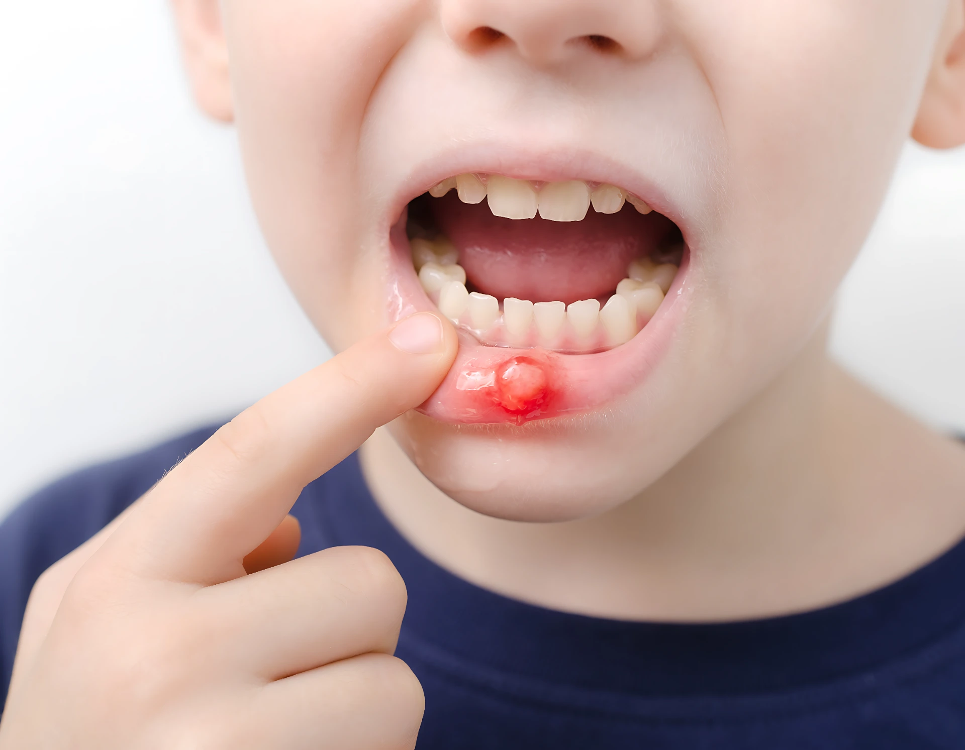Canker Sores: Prevention, Causes, and Treatment
