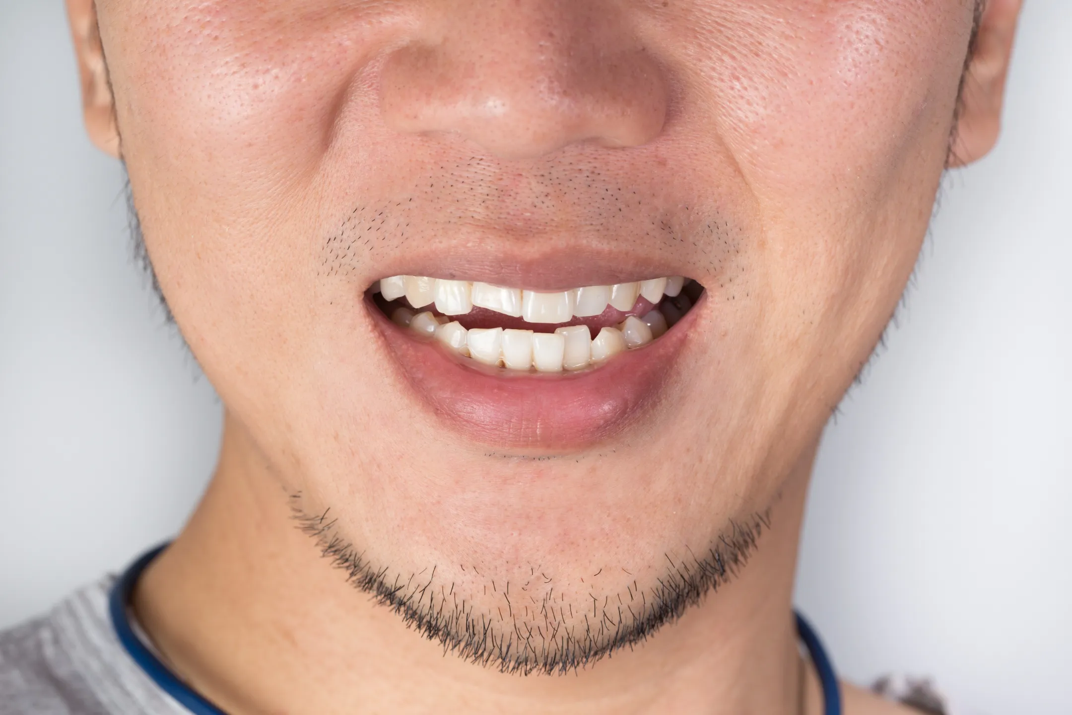 Traumatic Dental Injuries: What to Do When an Accident Damages a Tooth