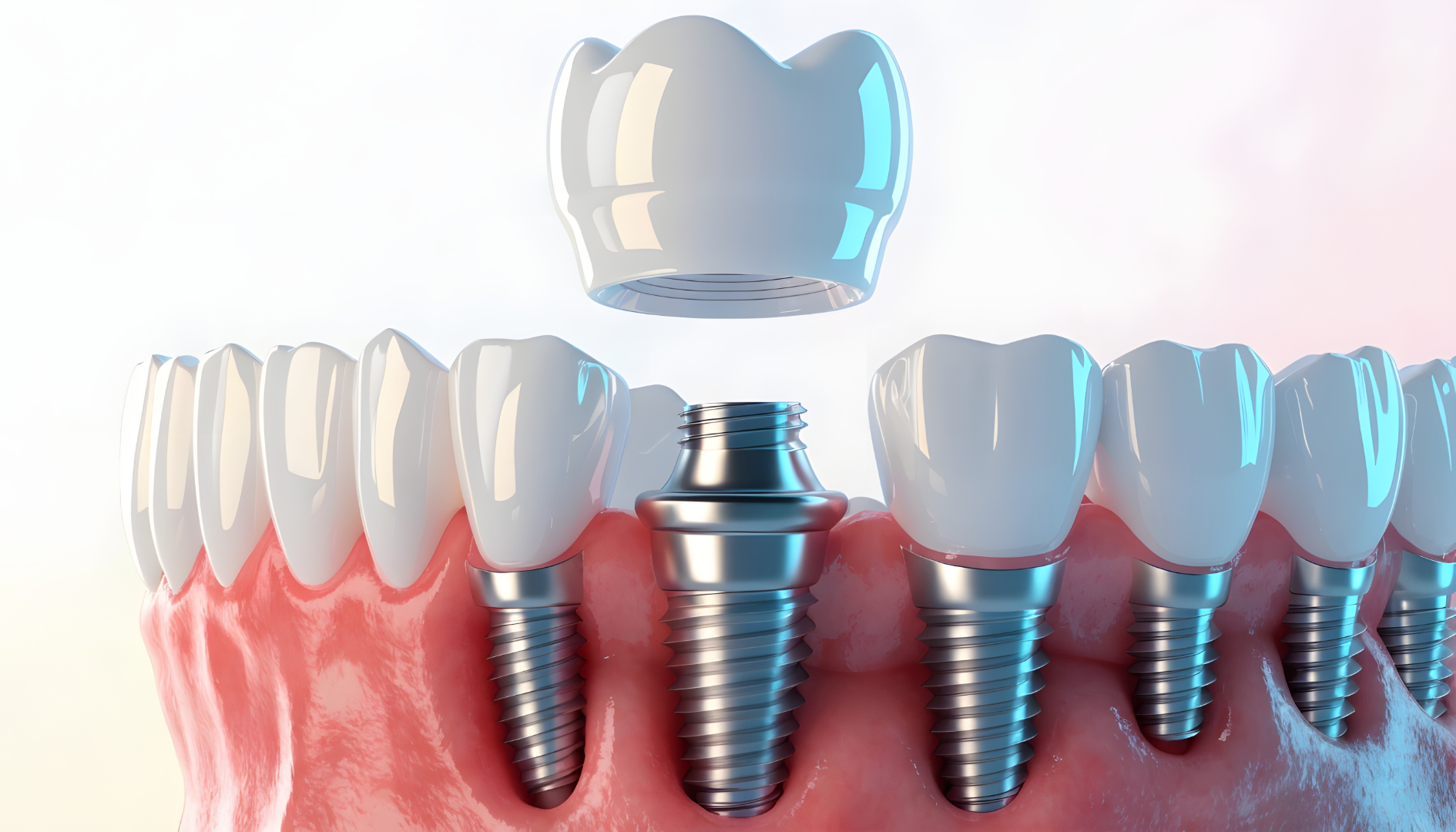Single Tooth Replacement: Comparing Your Options for One Missing Tooth