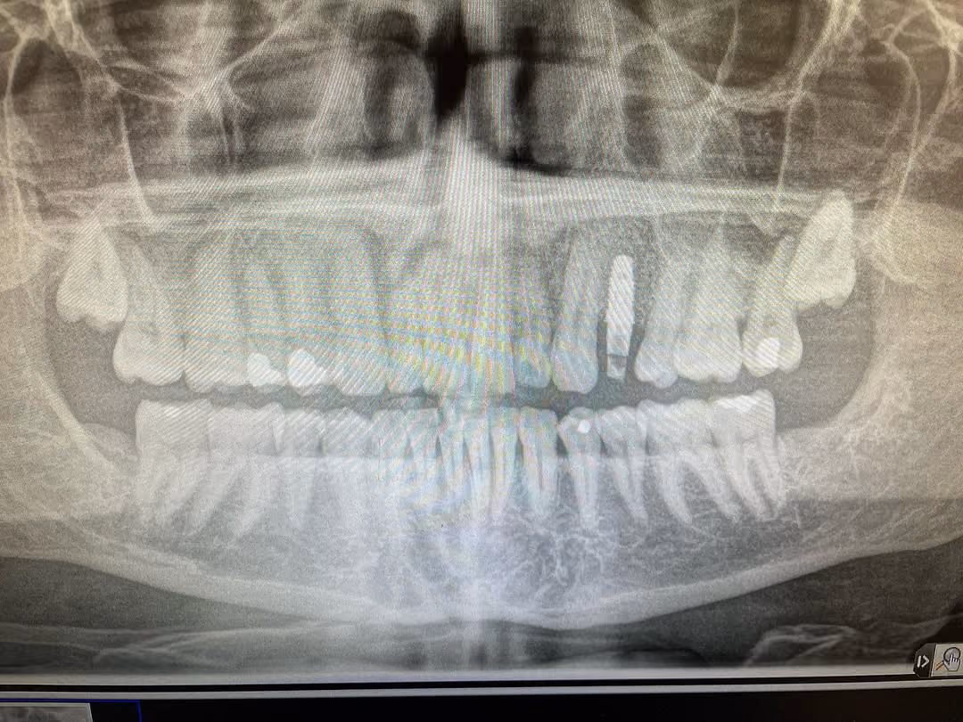Patient reviewing all-inclusive full-arch pricing