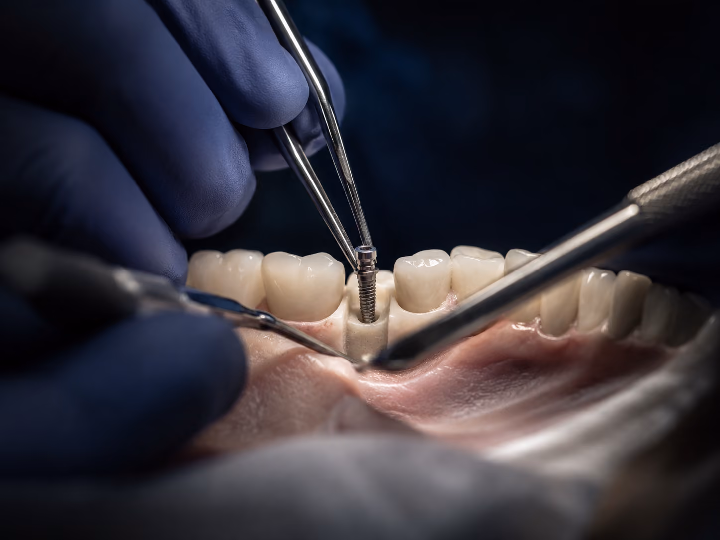 Single dental implant surgical placement procedure