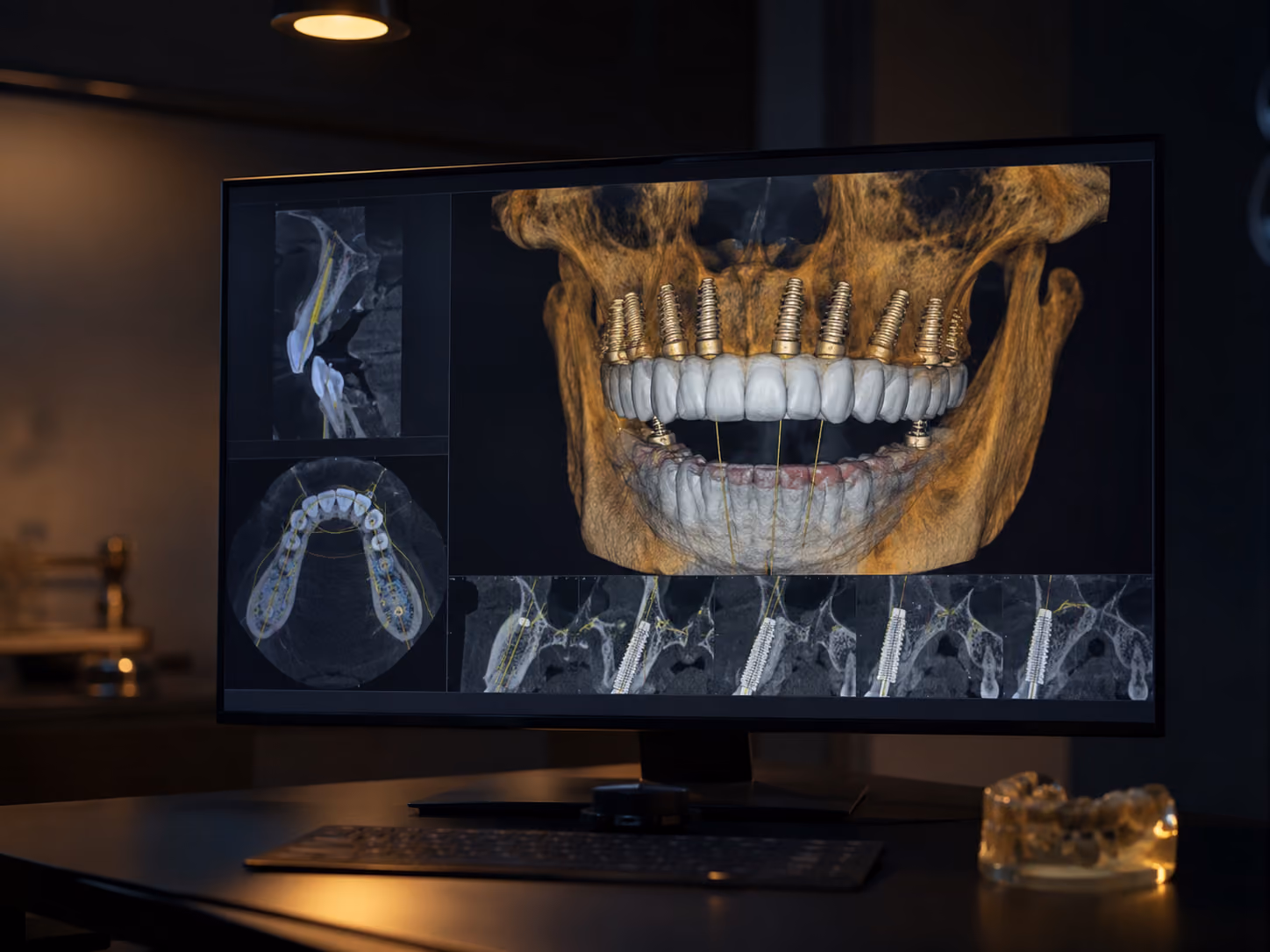 Dr. Volland reviewing a 3D CBCT scan to plan full-arch dental implant placement in Bonney Lake, WA