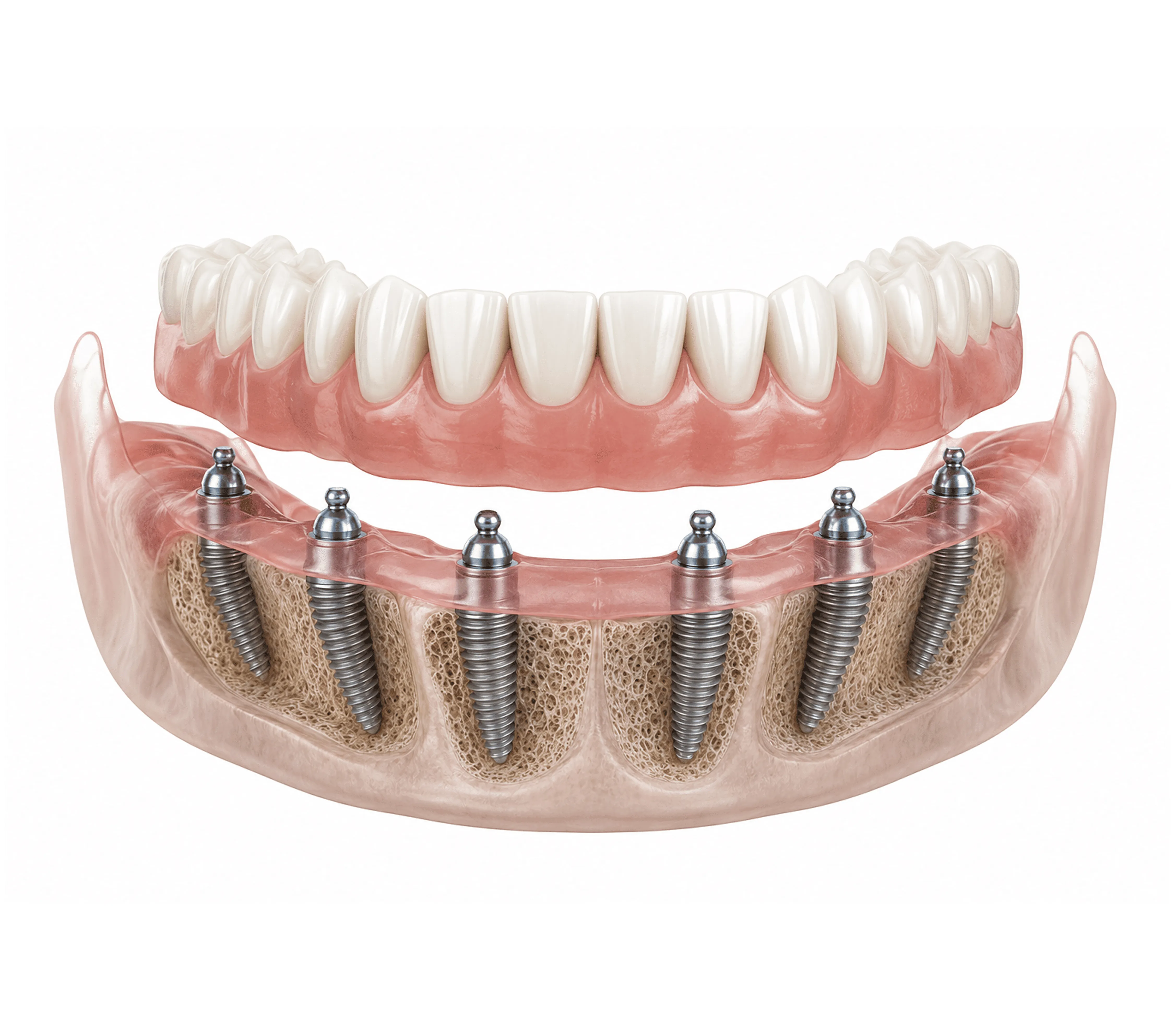 Diagram of All-on-6 dental implant placement with six implants per arch