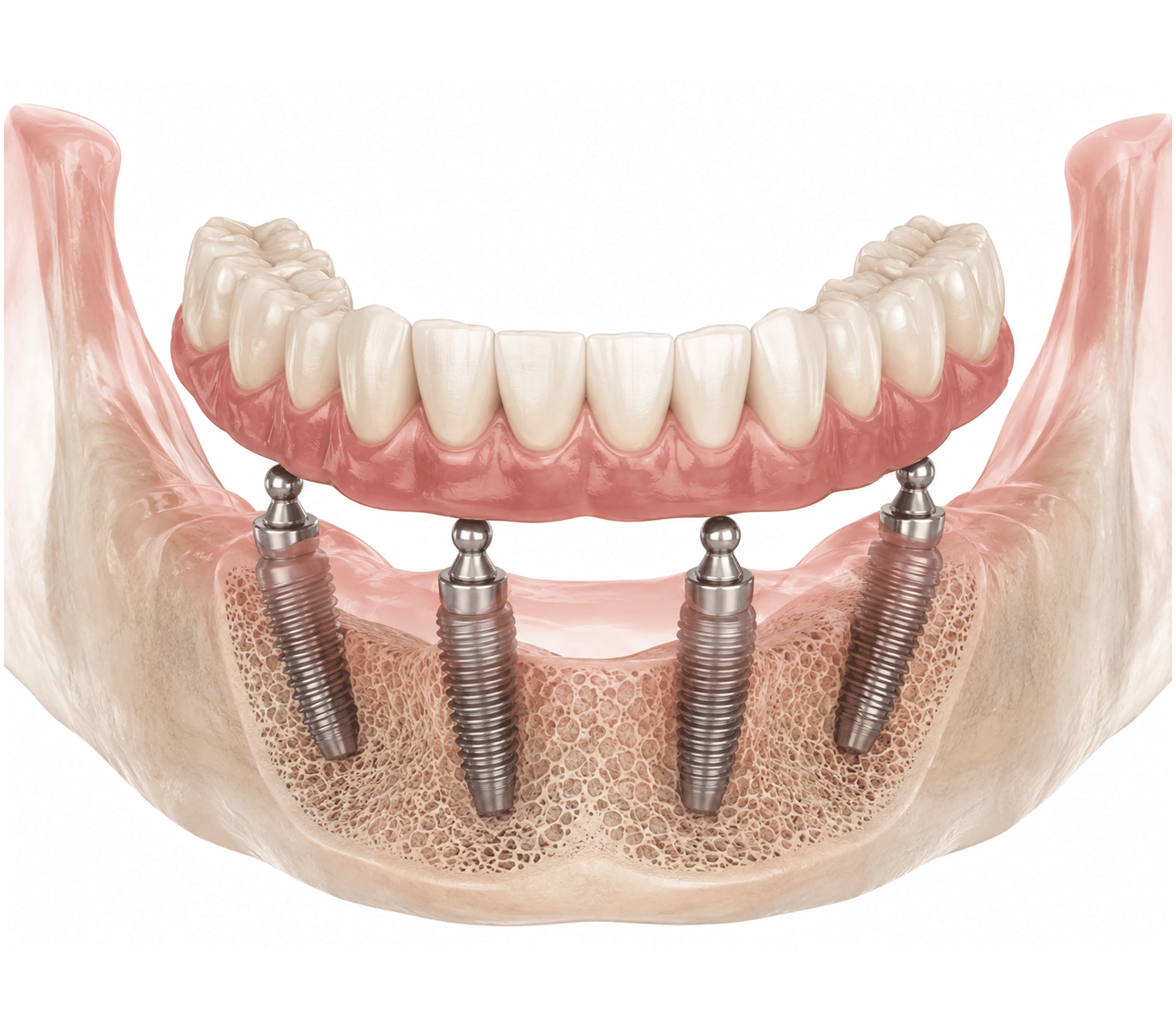 Diagram of All-on-4 dental implant placement with four implants per arch