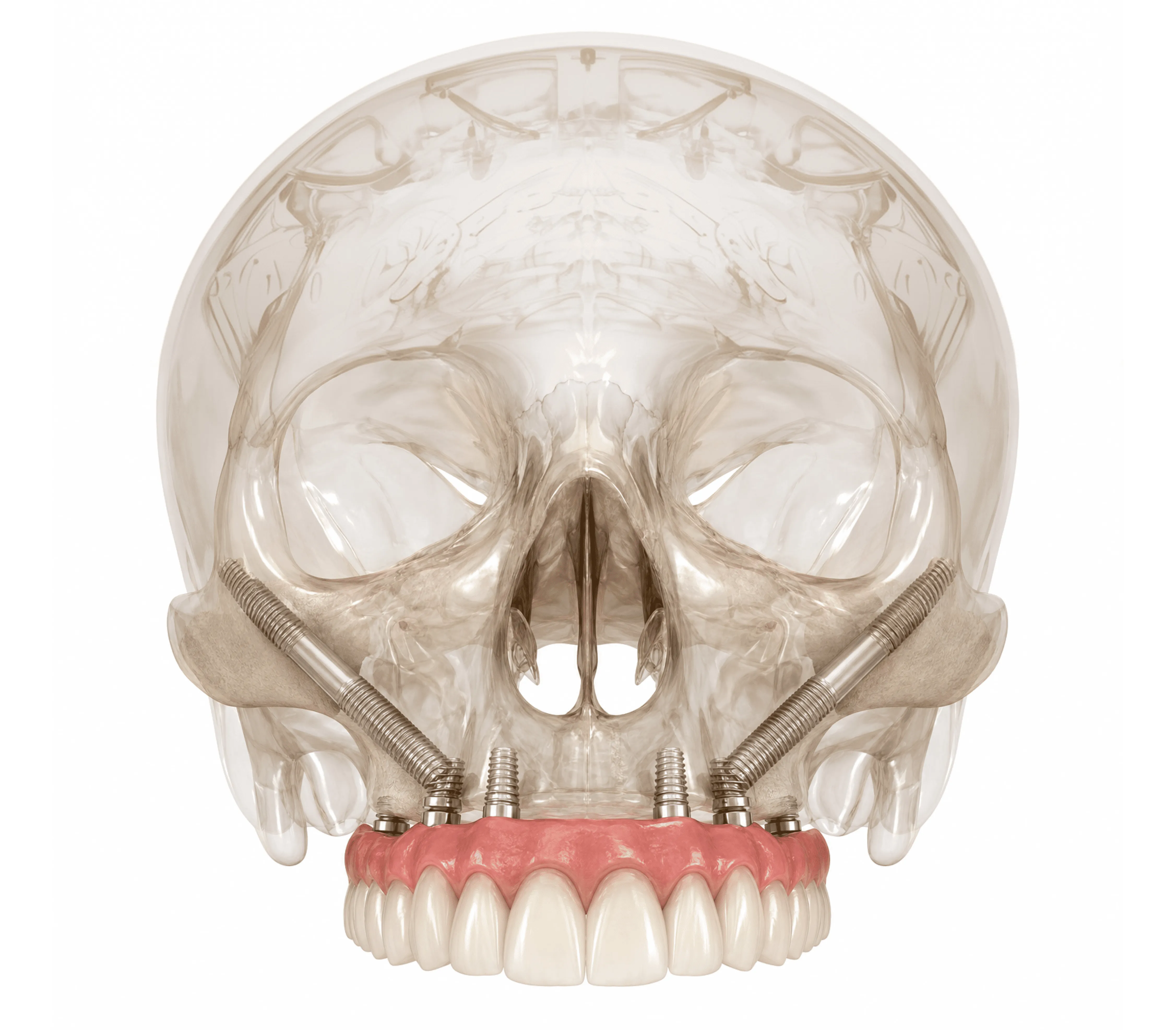 Illustration of zygomatic implants anchored in the cheekbone