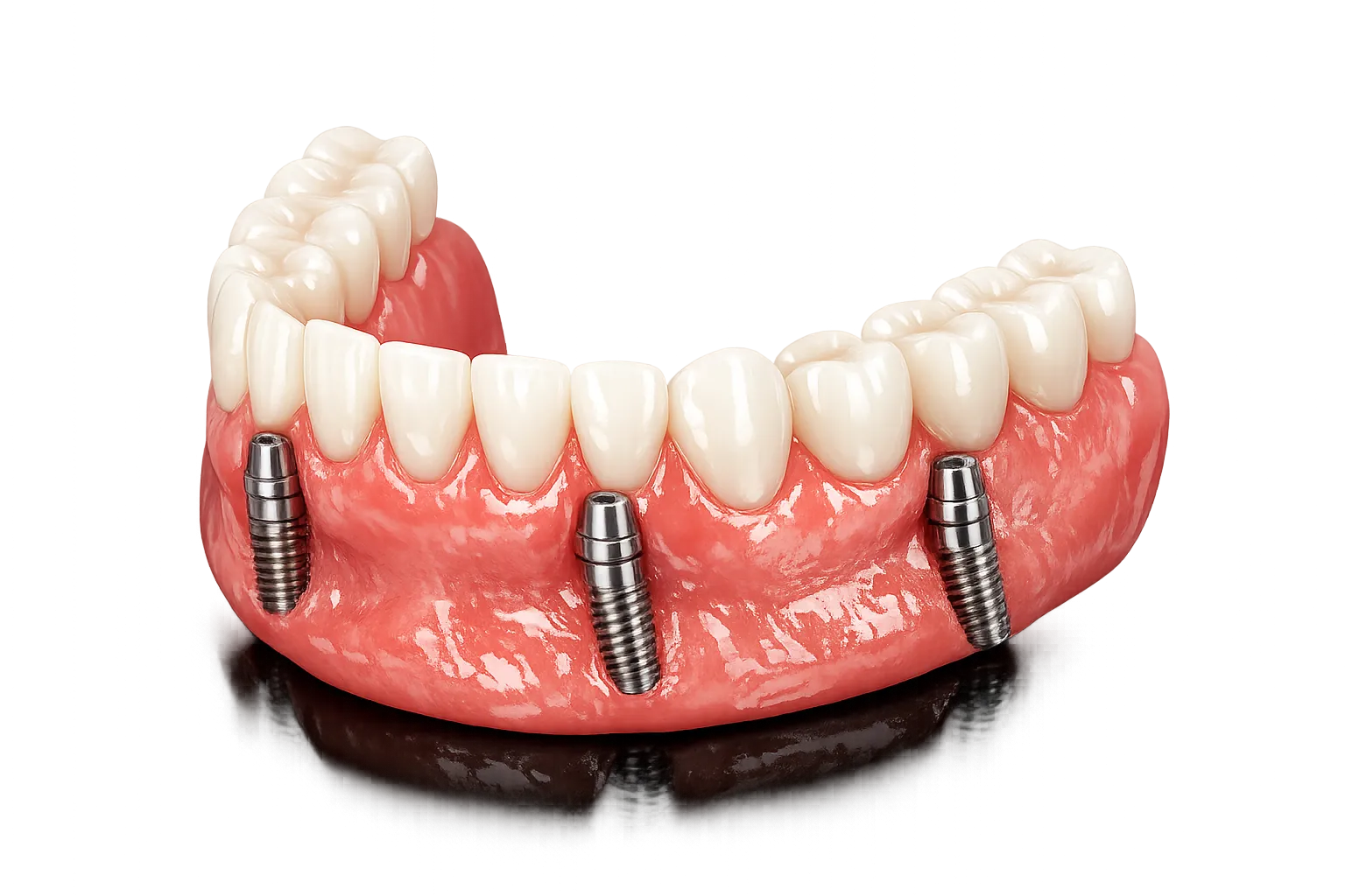 All-on-4 implant-supported fixed bridge anchored in the jawbone