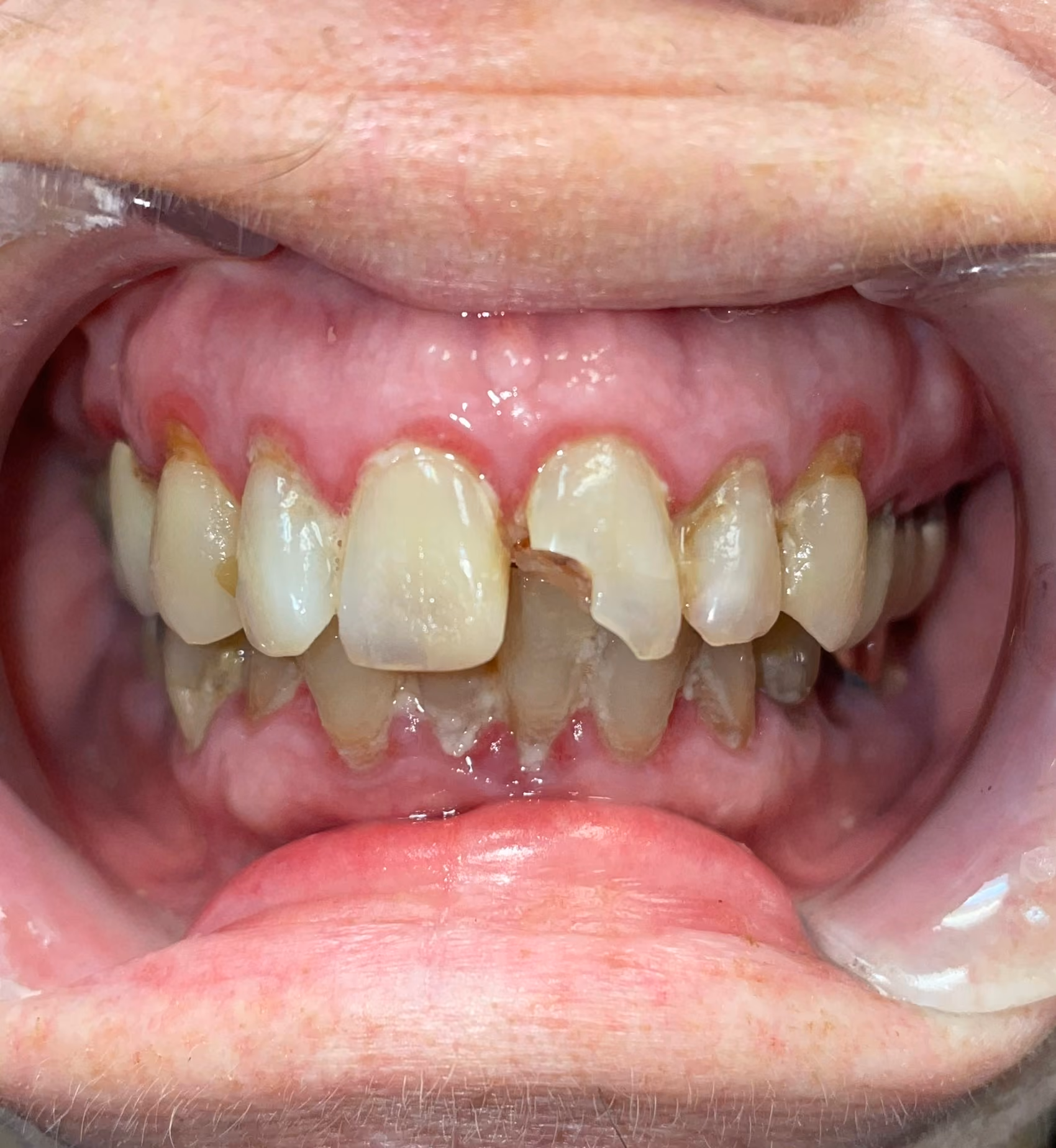 Before: upper teeth with severe wear, fracture, and discoloration