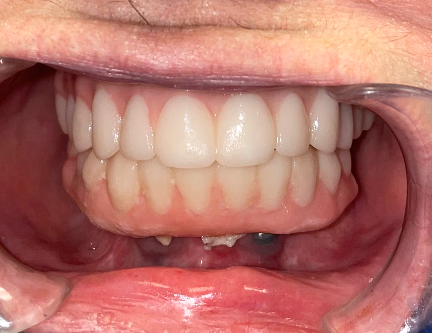 After: upper arch restored with an implant-supported fixed prosthesis