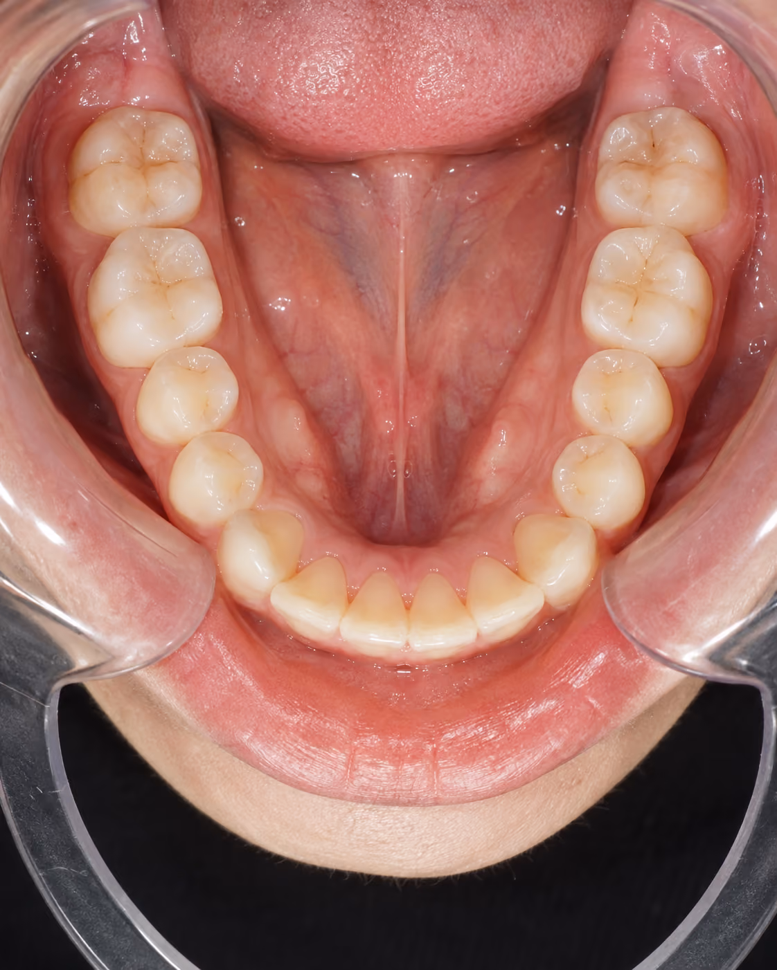 Example photo: lower arch viewed from above with chin down