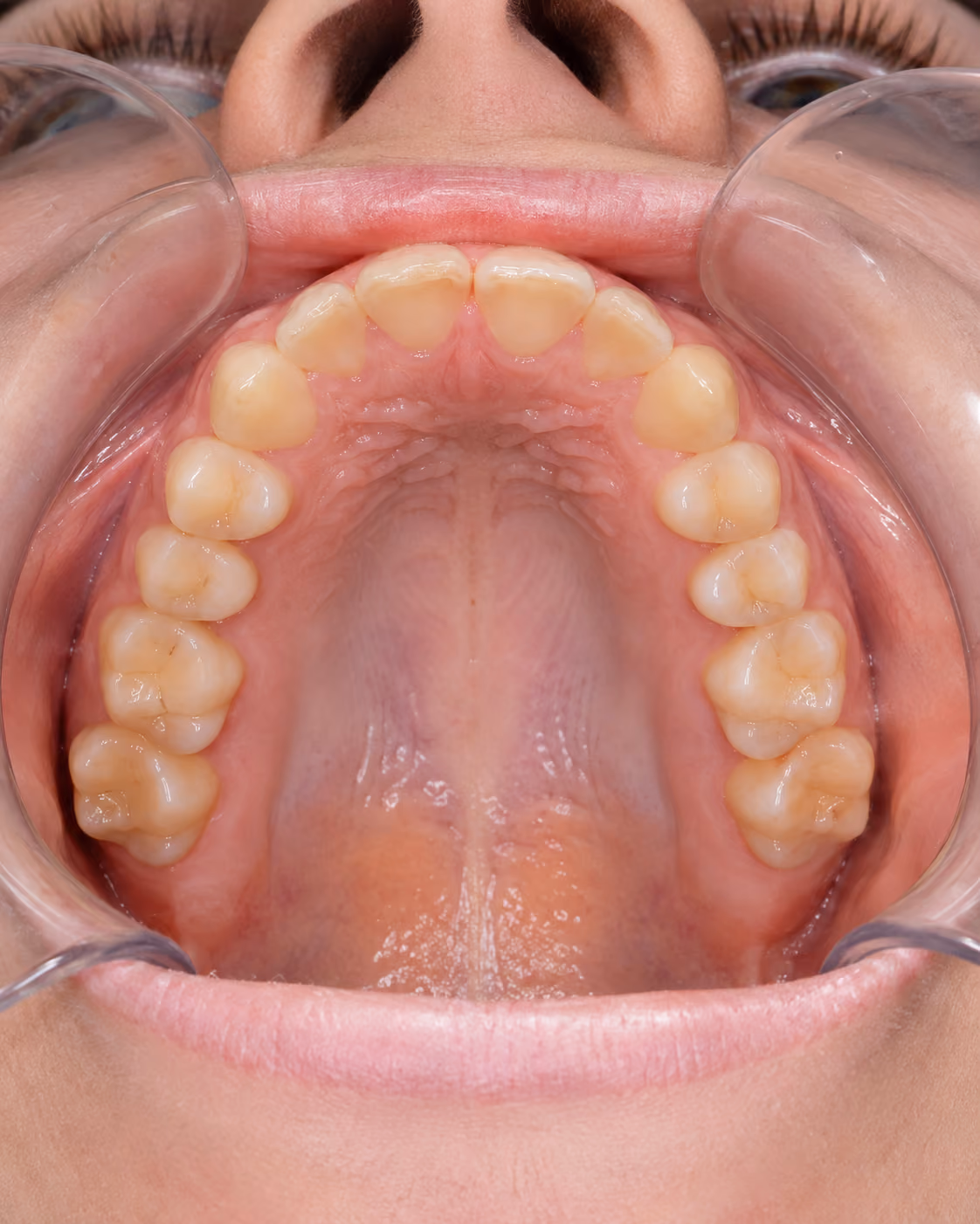 Example photo: upper arch viewed from below with head tilted back