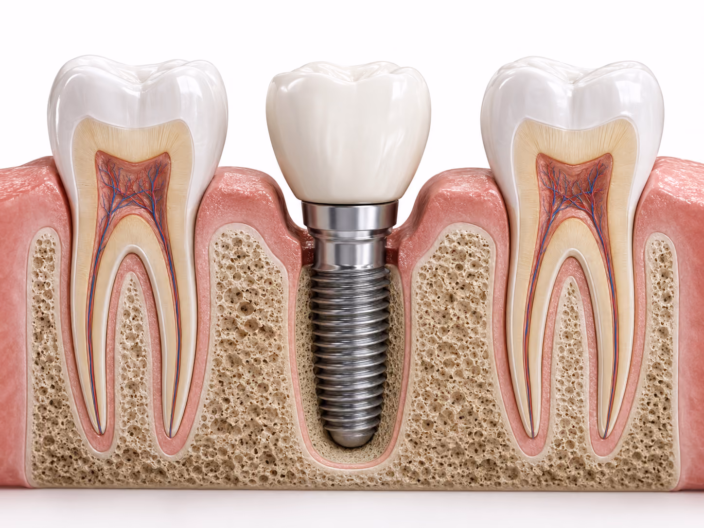 Illustration of a single dental implant replacing one missing tooth