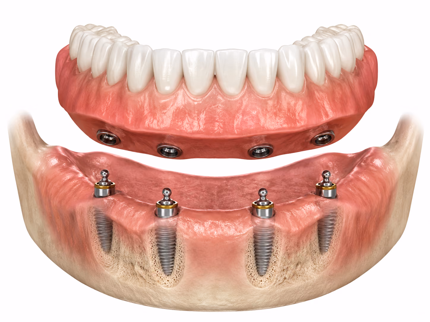 3D illustration of a removable lower snap-in denture with four implant attachments and matching locator housings.