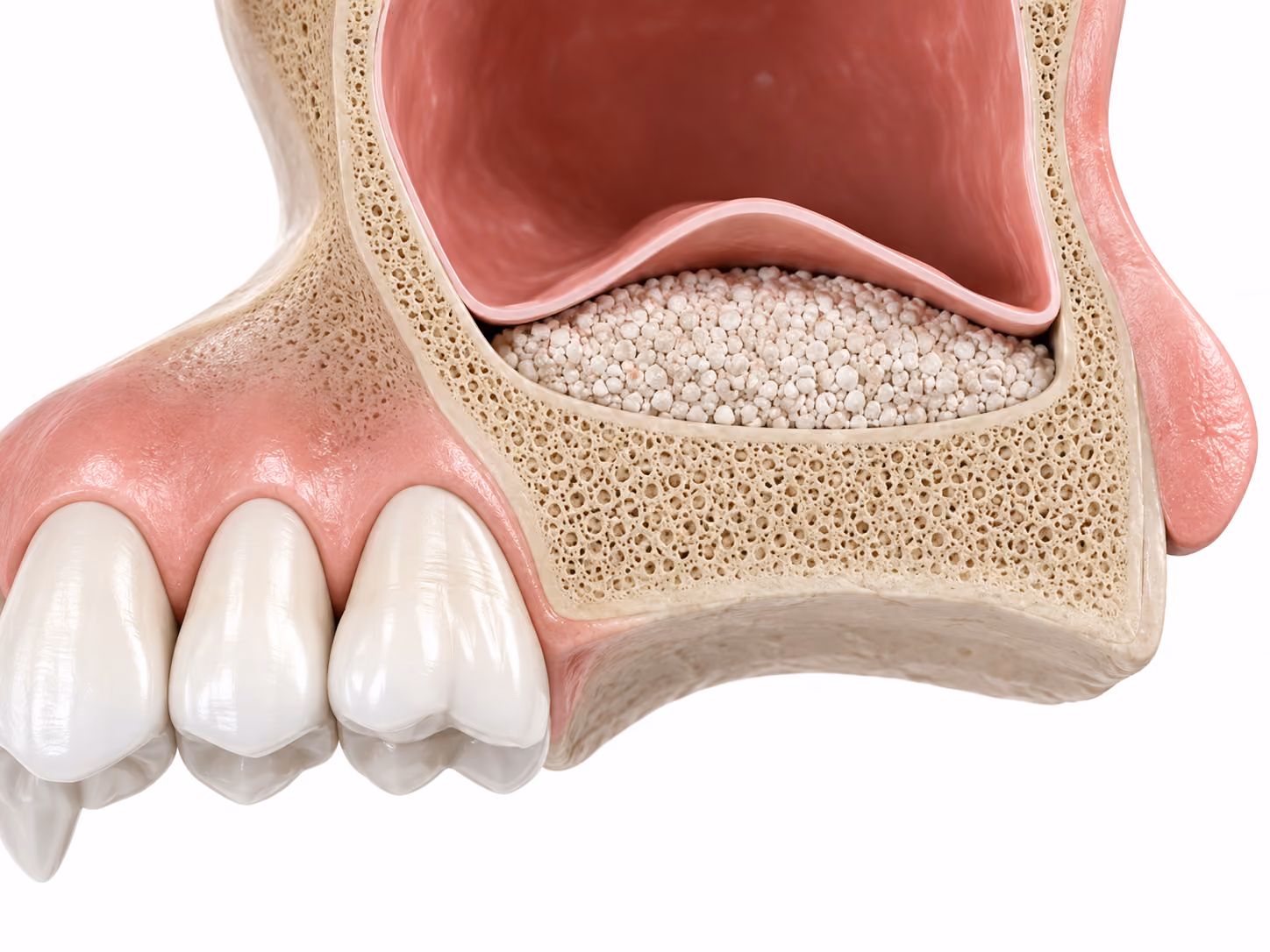 Cross-section 3D illustration of a sinus lift showing the maxillary sinus membrane elevated above bone graft material in the upper jaw.