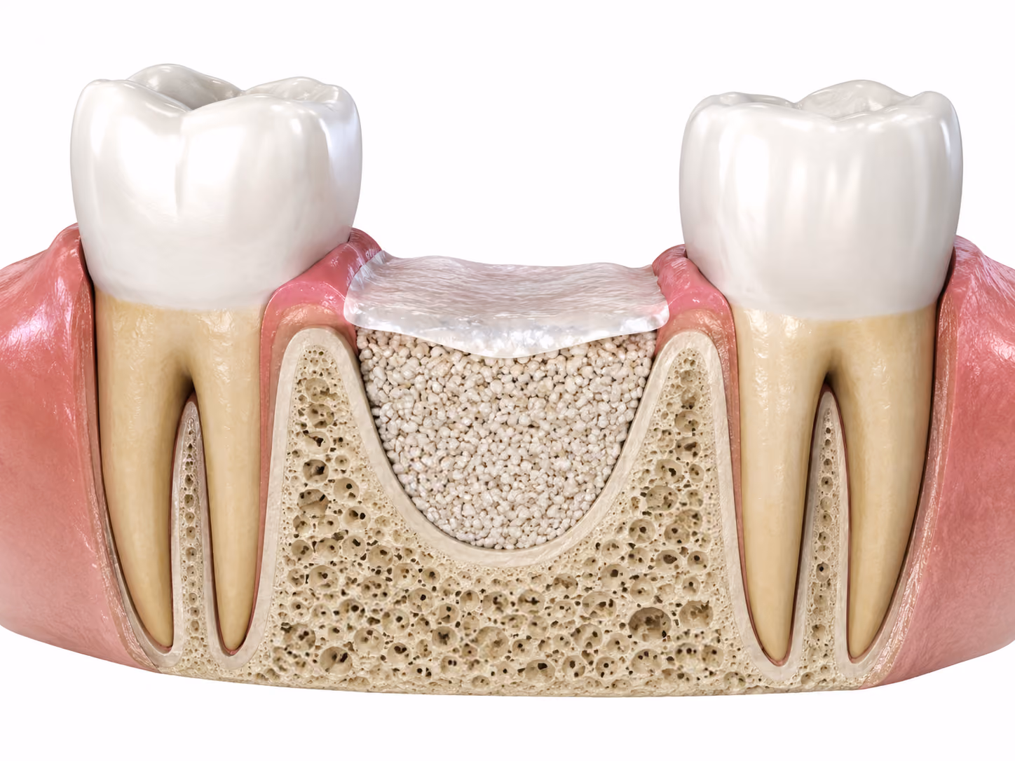 Cross-section illustration of bone graft material and a protective membrane rebuilding a missing tooth site between two natural teeth.
