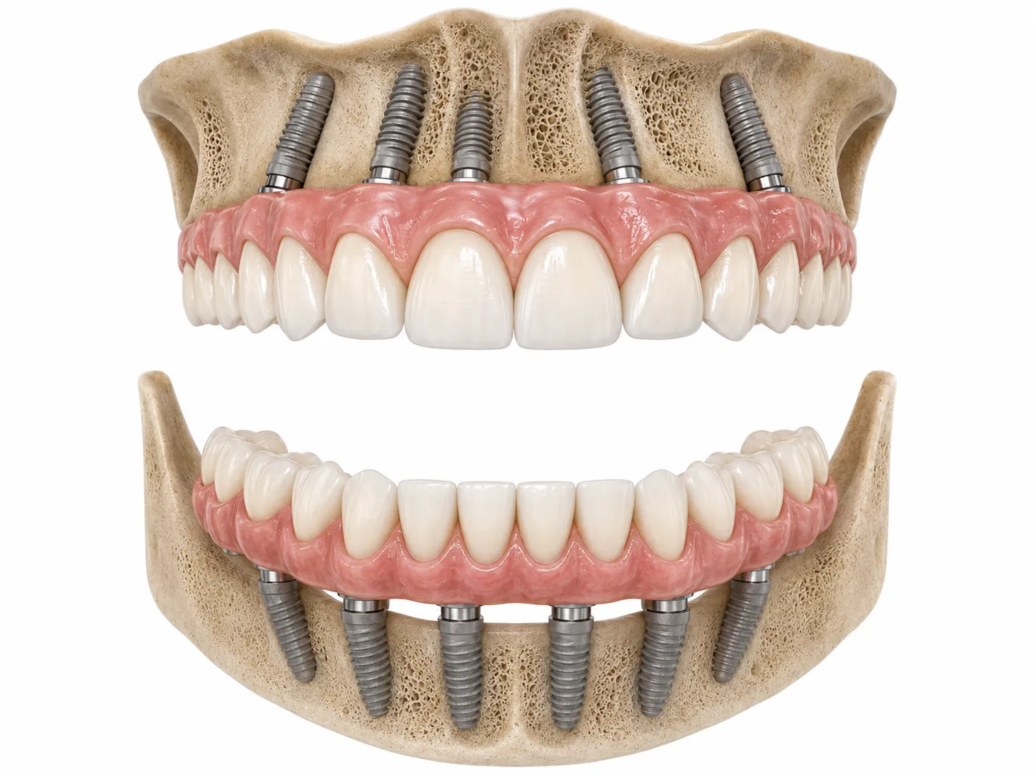 3D illustration of upper and lower full-arch dental bridges supported by multiple titanium implants in the jawbone.