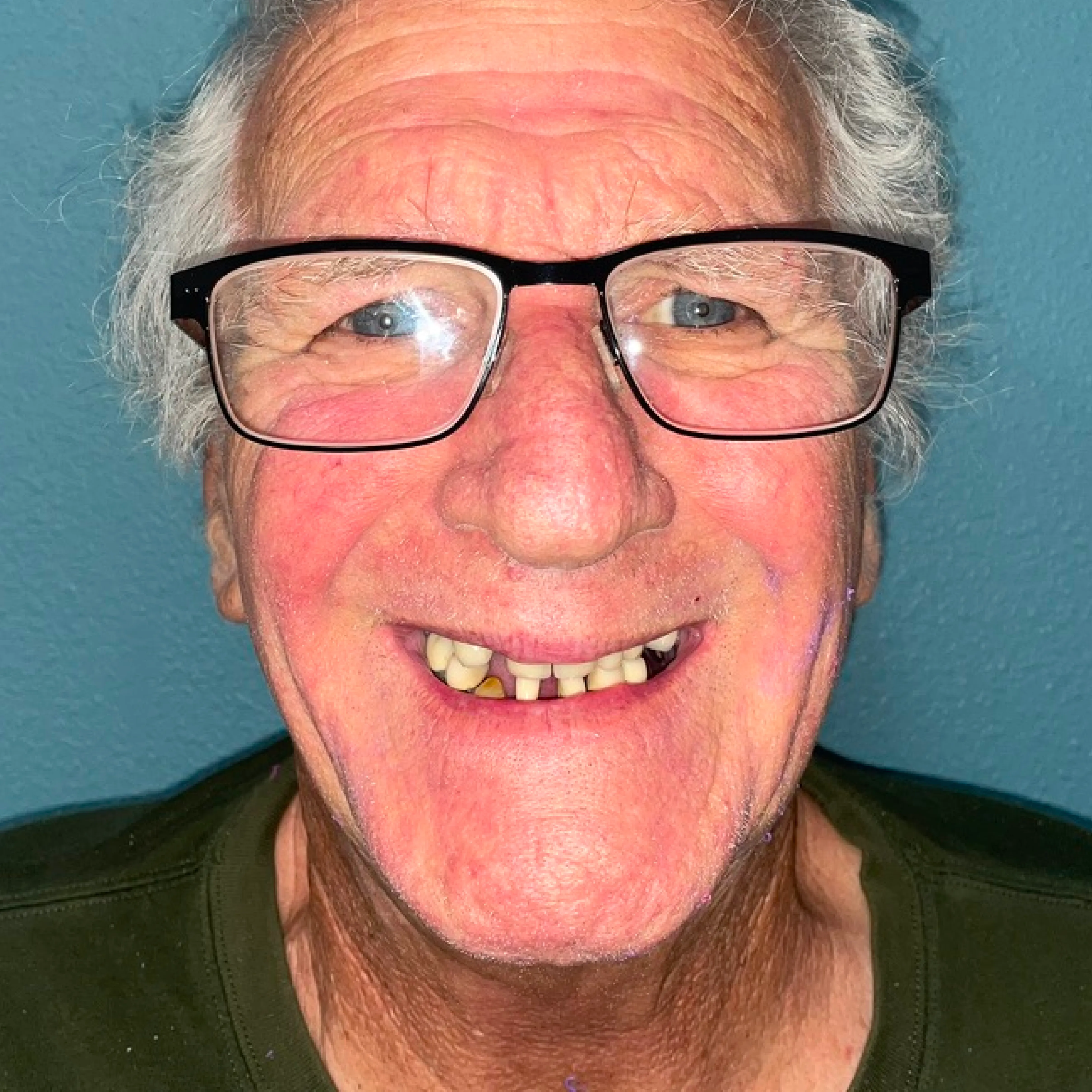 Before: upper ridge with significant bone resorption from long-term denture wear