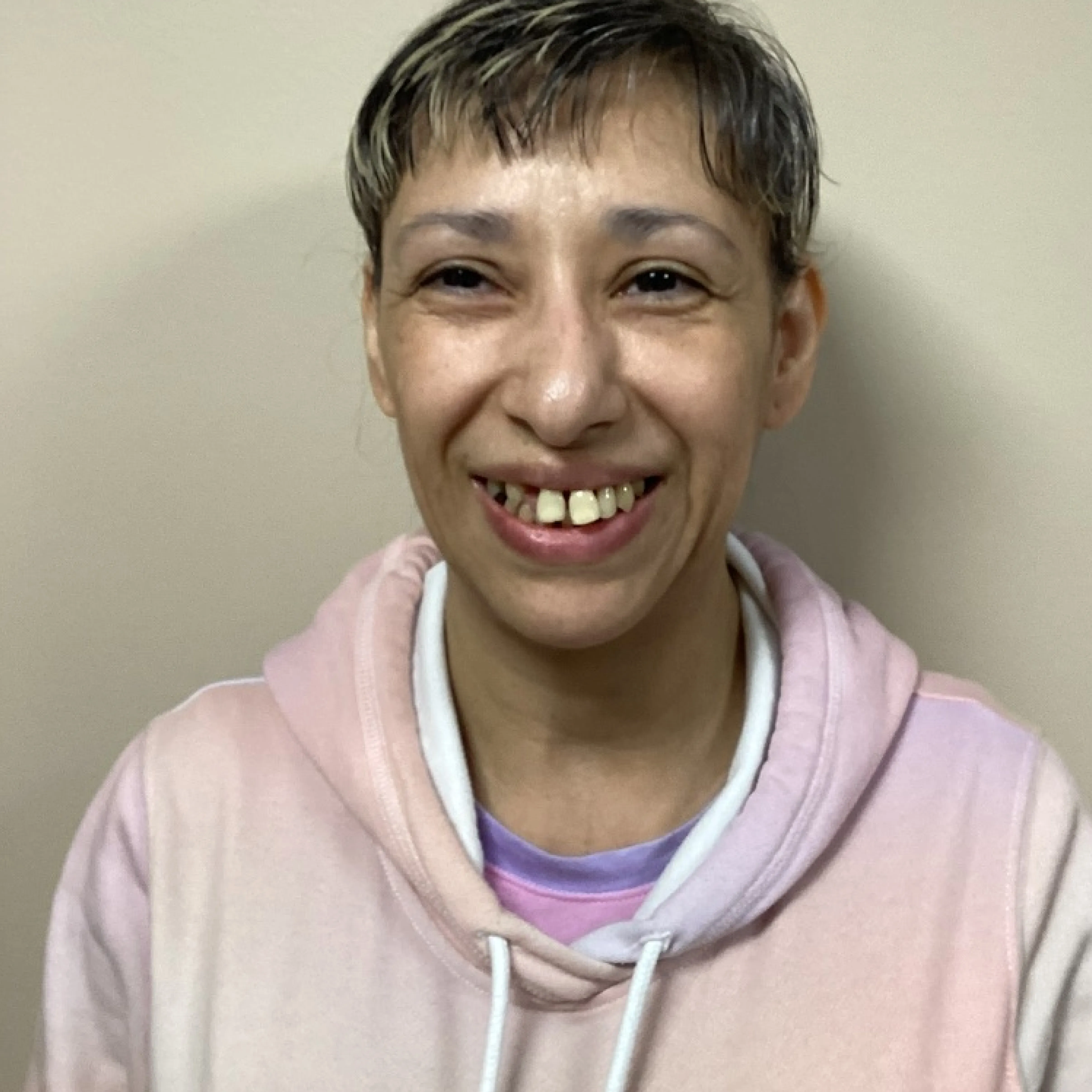 Before: upper arch with advanced periodontal bone loss and mobile teeth