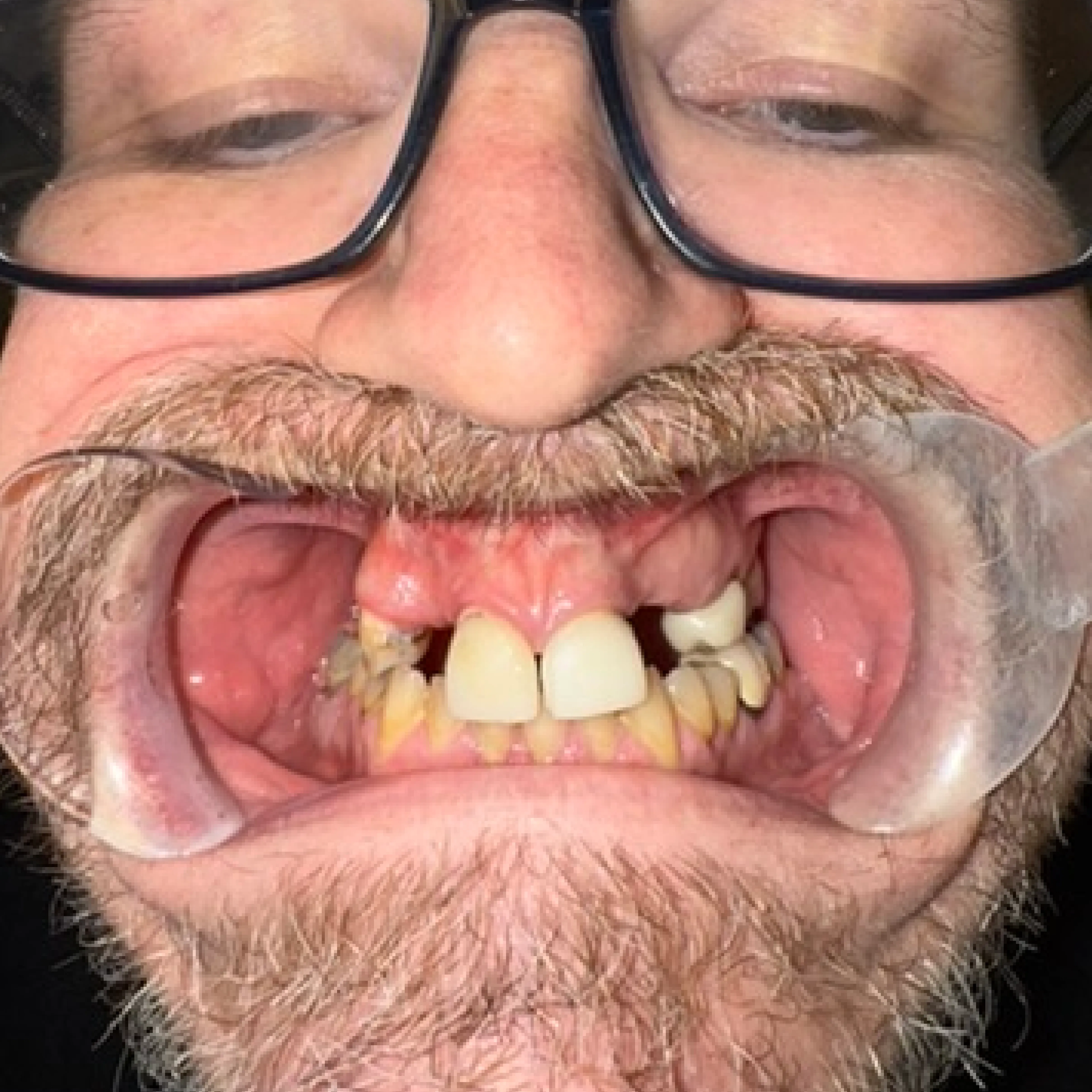 Before: broken and heavily restored teeth with recurrent decay at the gum line