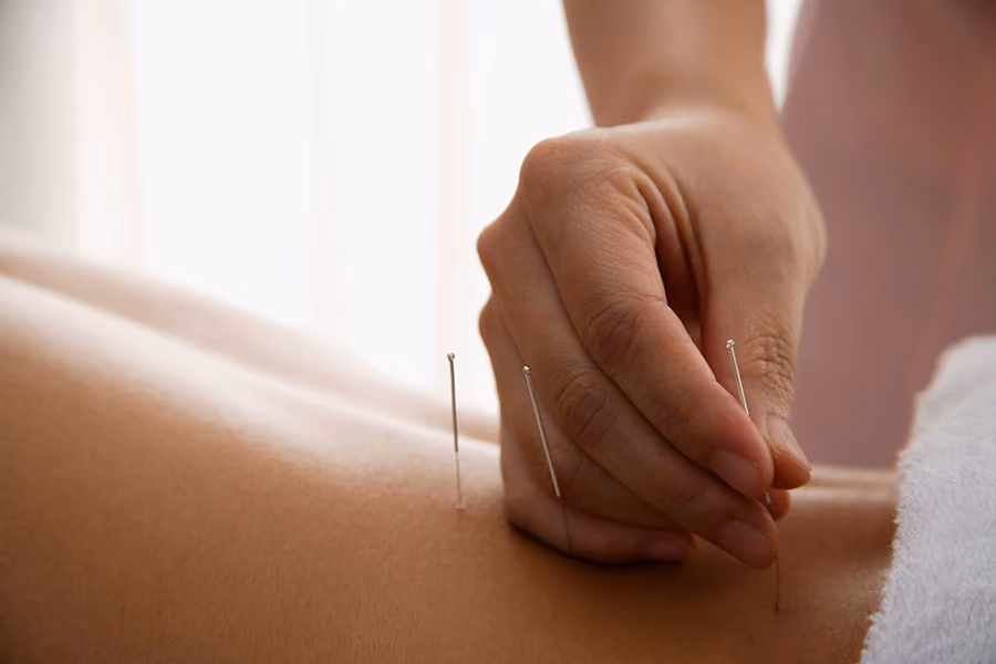 acupuncture needle