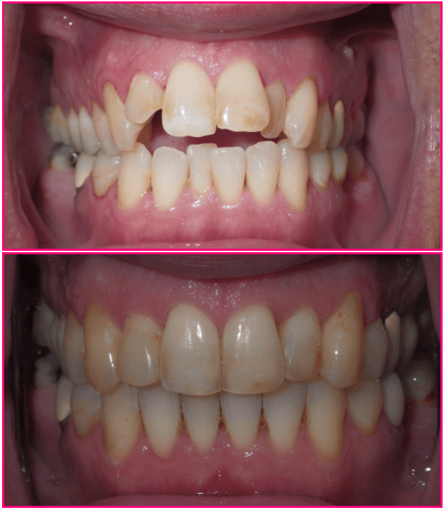 Open mouth showing a before and after dental treatment comparison, with improved teeth alignment and appearance.