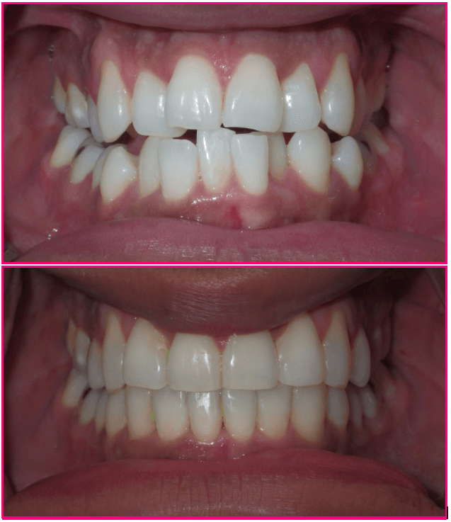 Comparison of teeth before and after orthodontic treatment, showing noticeable alignment improvement.