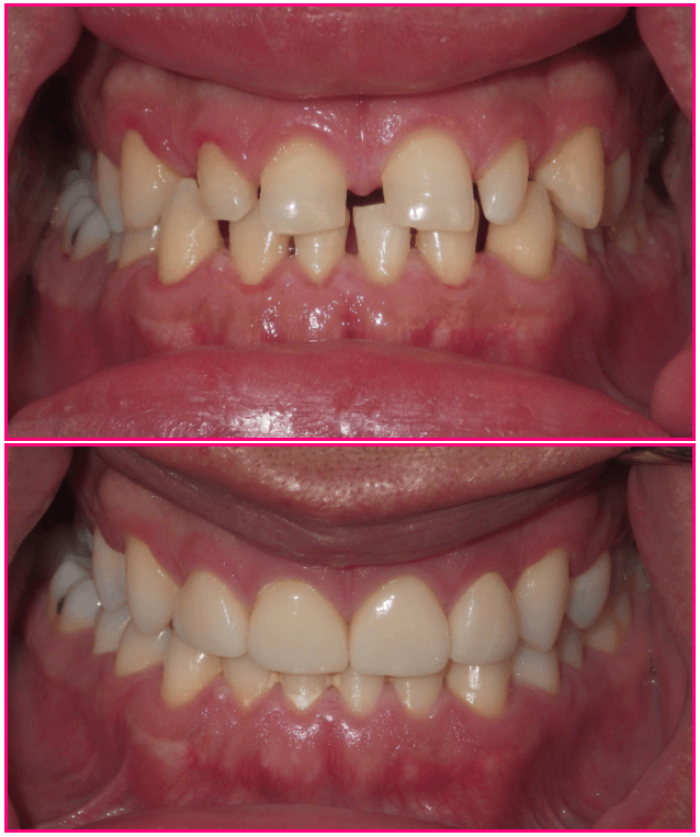 Close-up of teeth before and after dental treatment, showing significant improvement and alignment.