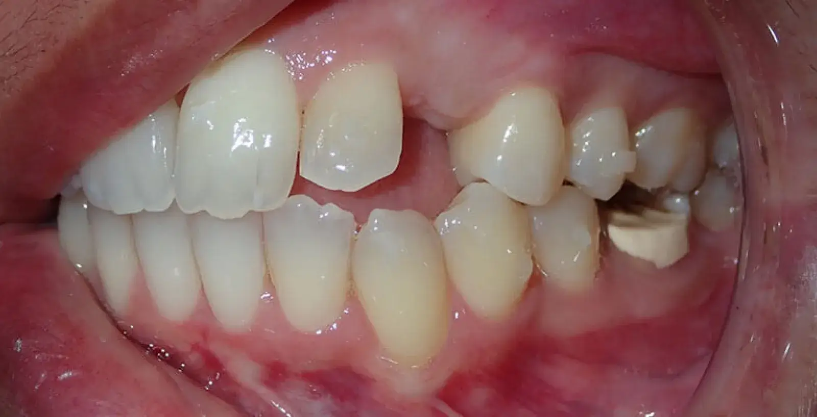 Close-up of a human mouth showing upper and lower teeth with a missing upper front tooth and visible dental work on a lower molar.