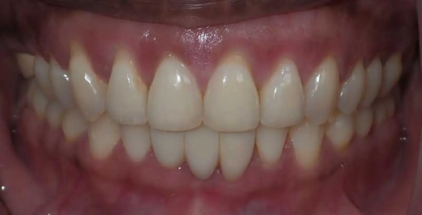 Close-up of a person's teeth showing a straight, clean dental alignment with healthy gums.