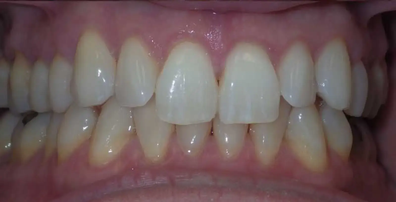 Close-up of a person's clean, well-aligned teeth with healthy pink gums.