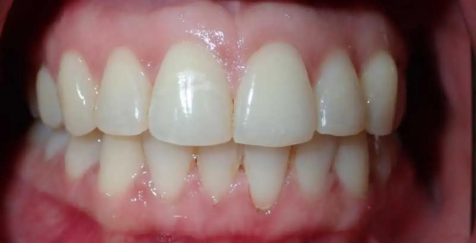 Close-up of a person's teeth, showing both the upper and lower sets clearly.