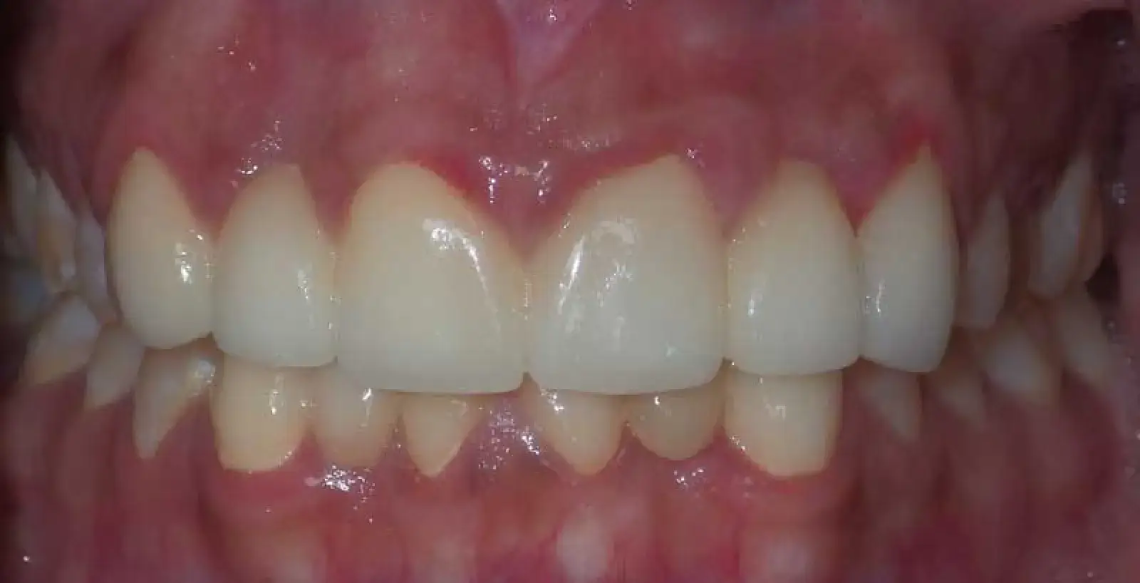 Close-up of a person's upper and lower teeth showing healthy gums and clean teeth.