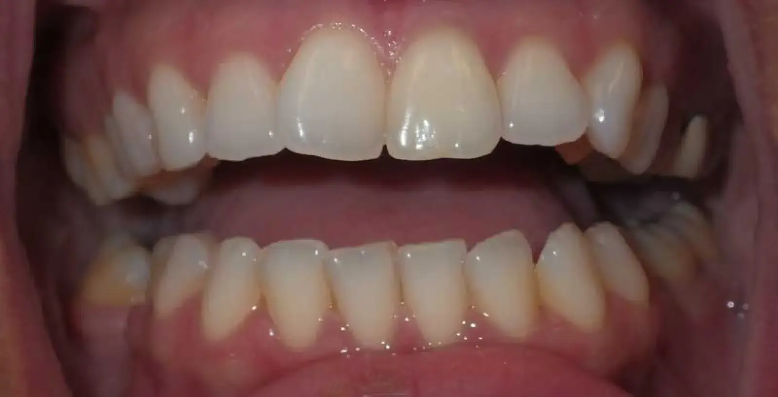 A close-up of a person's mouth showing well-aligned upper and lower teeth.