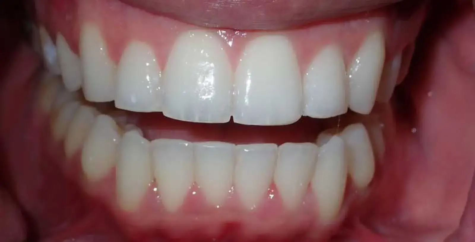A close-up of a person's smiling teeth, showing healthy gums and aligned white teeth.